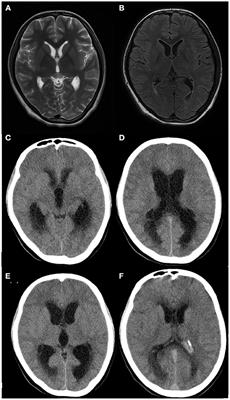 A Retrospective Study of Rare Listeria Meningoencephalitis in Immunocompetent Children in China